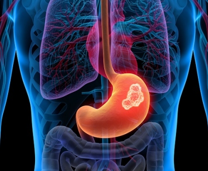 Ung thư dạ dày có thể chữa khỏi hoàn toàn không